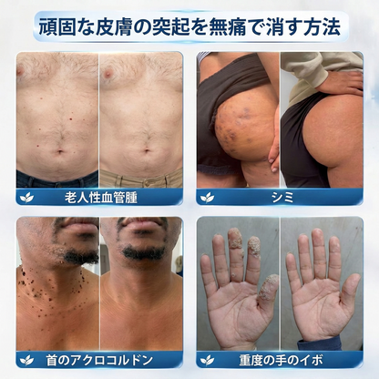 PuraCure®👩‍⚕️ 7日間で実感 イボ・気になる肌悩み用 消すローラーペン｜痛みなし・跡が残りにくい