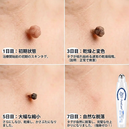 PuraCure®👩‍⚕️ 7日間で実感 イボ・気になる肌悩み用 消すローラーペン｜痛みなし・跡が残りにくい